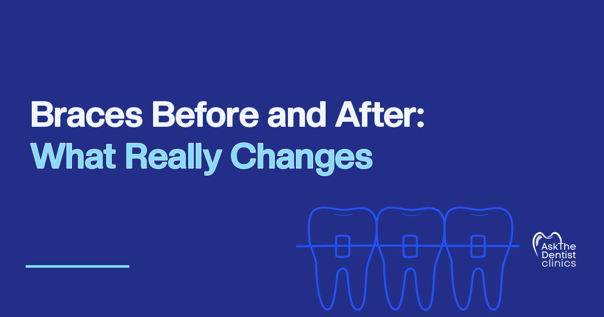 Braces Before and After: What Really Changes title card with an outline of teeth with braces