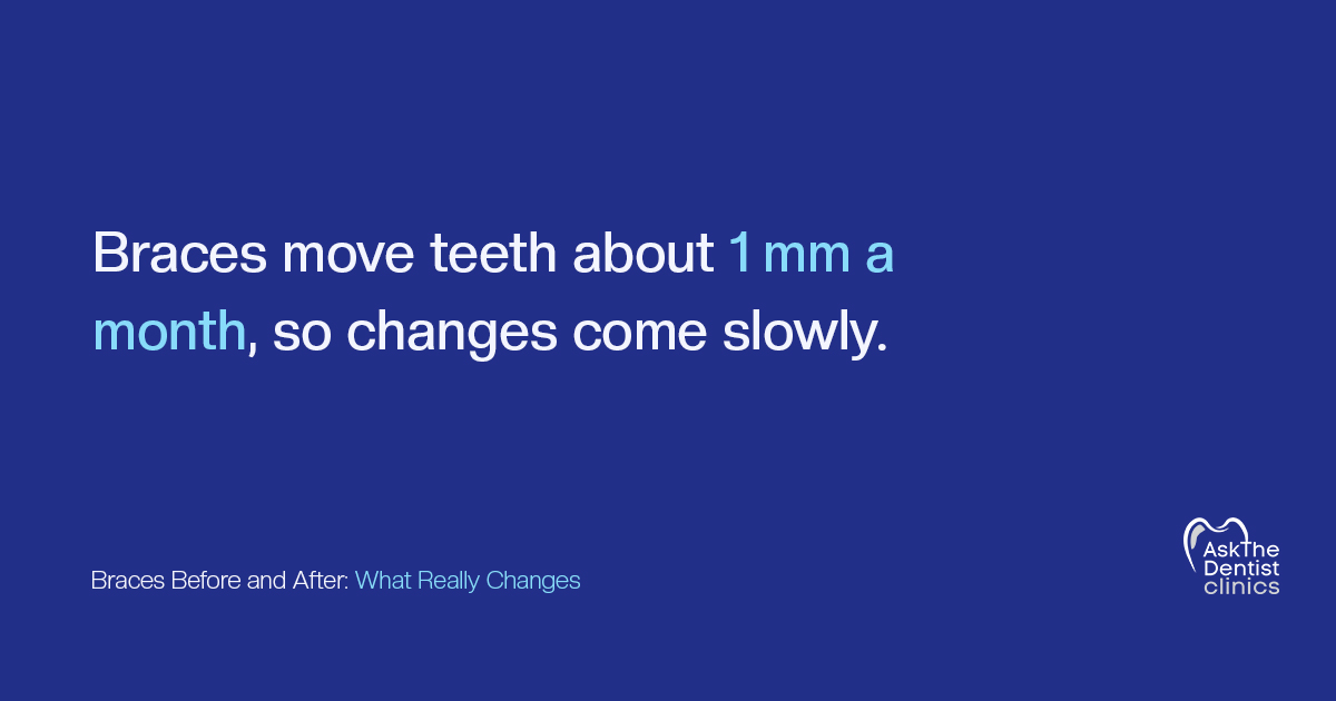 Braces move teeth about 1 mm a month, so changes come slowly