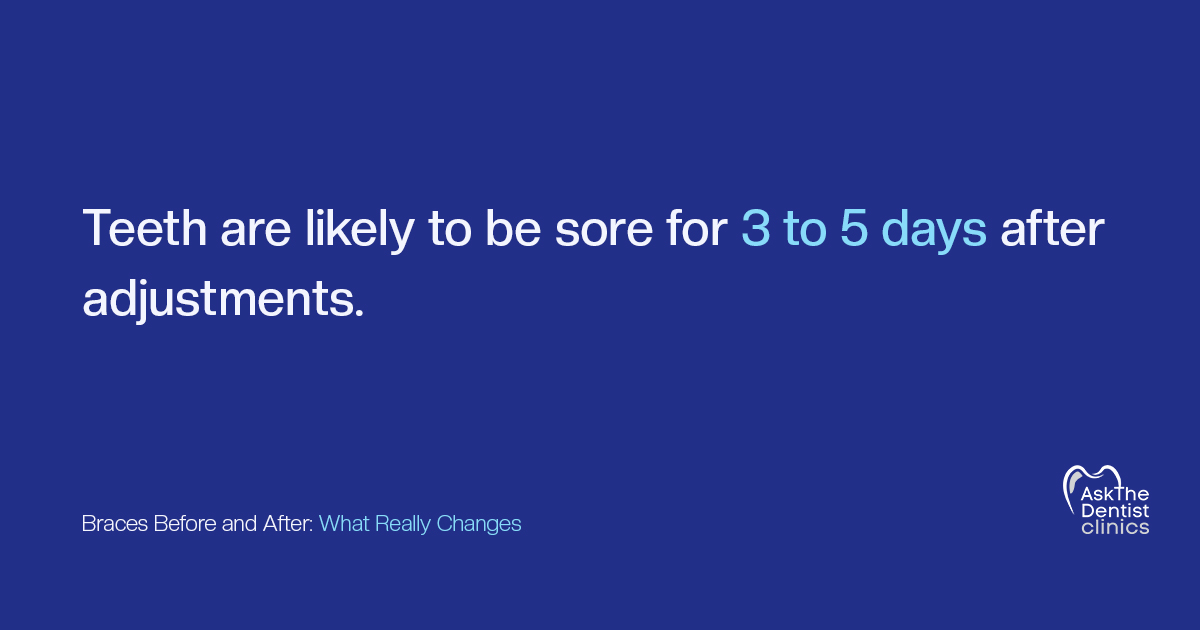 Teeth are likely to be sore for 3 to 5 days after braces adjustments