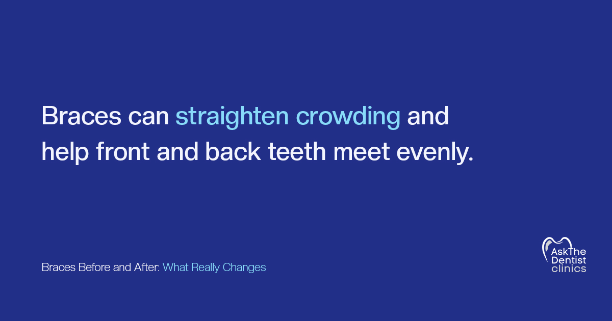 Braces can straighten crowding and help front and back teeth meet evenly