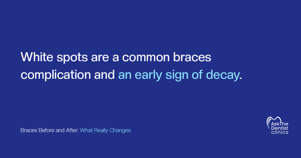 White spots are a common braces complication and an early sign of decay
