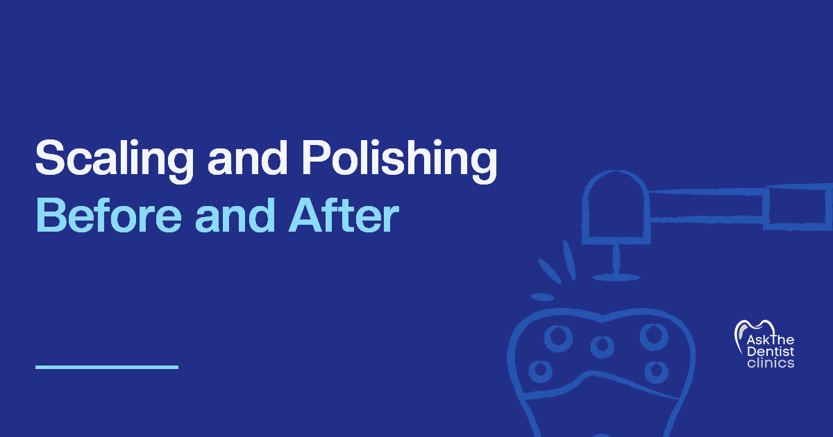 Scaling and Polishing Before and After title card