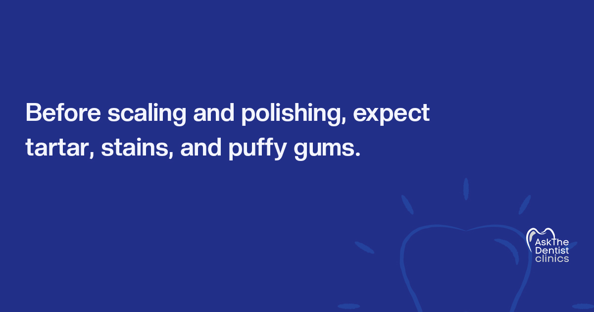 Before scaling and polishing, expect tartar, stains and puffy gums