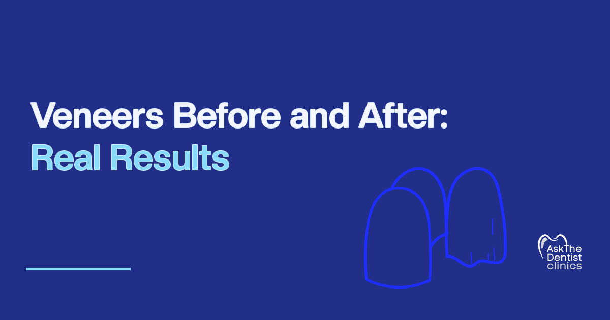 Veneers Before and After: Real Results title card