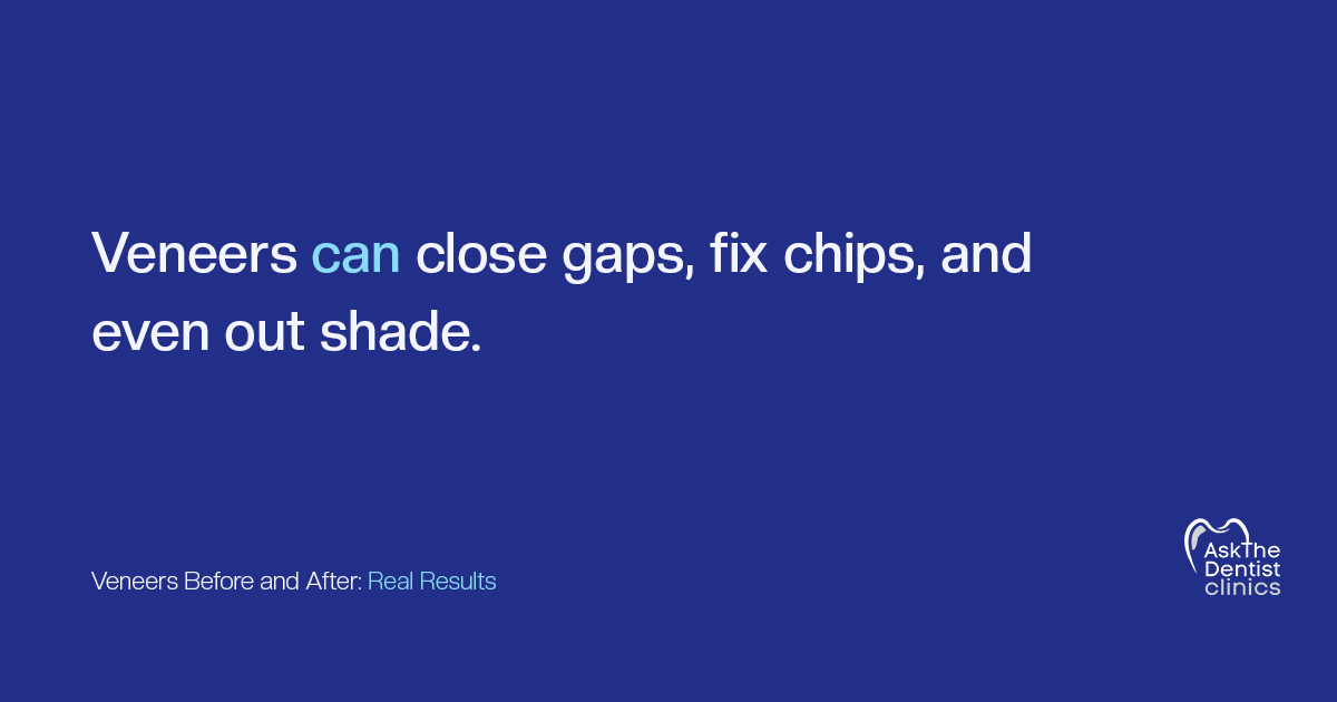 Veneers can close gaps, fix chips and even out shade