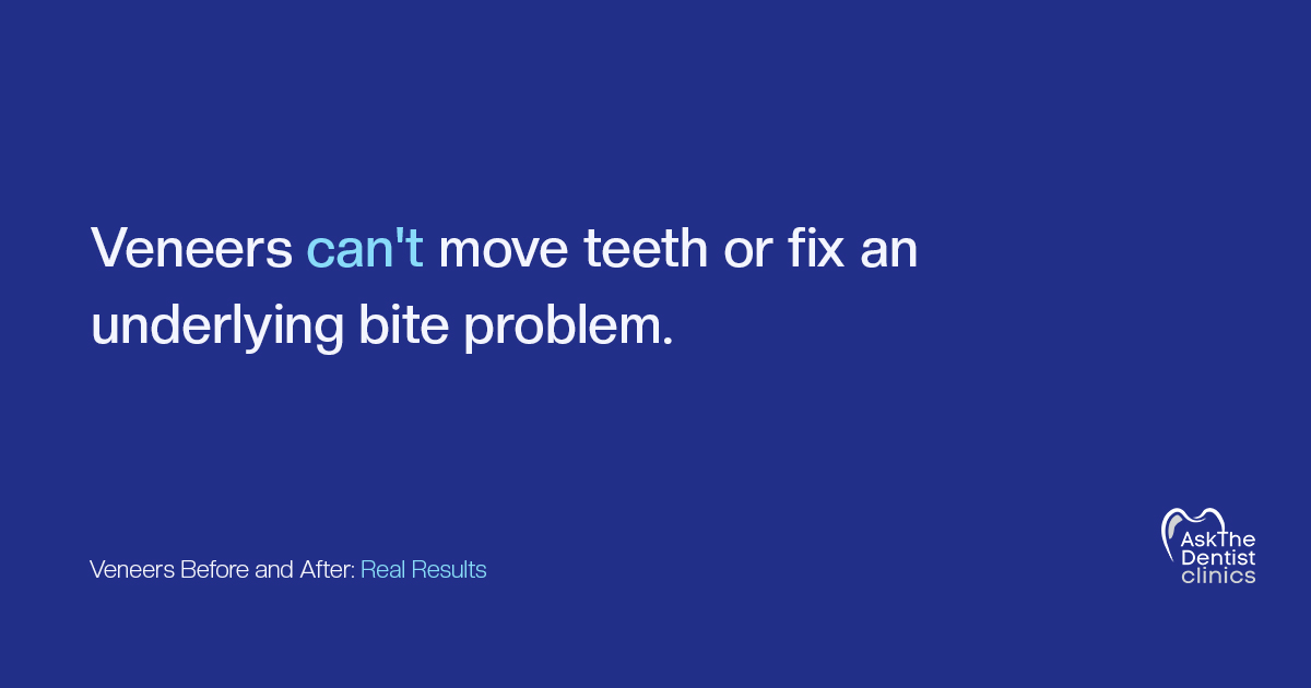 Veneers can't move teeth or fix an underlying bite problem