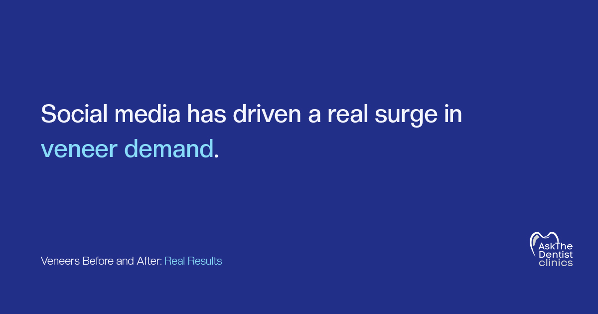 Social media has driven a real surge in veneer demand