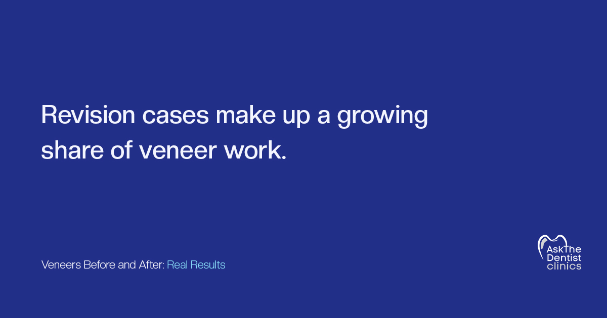 Revision cases make up a growing share of veneer work