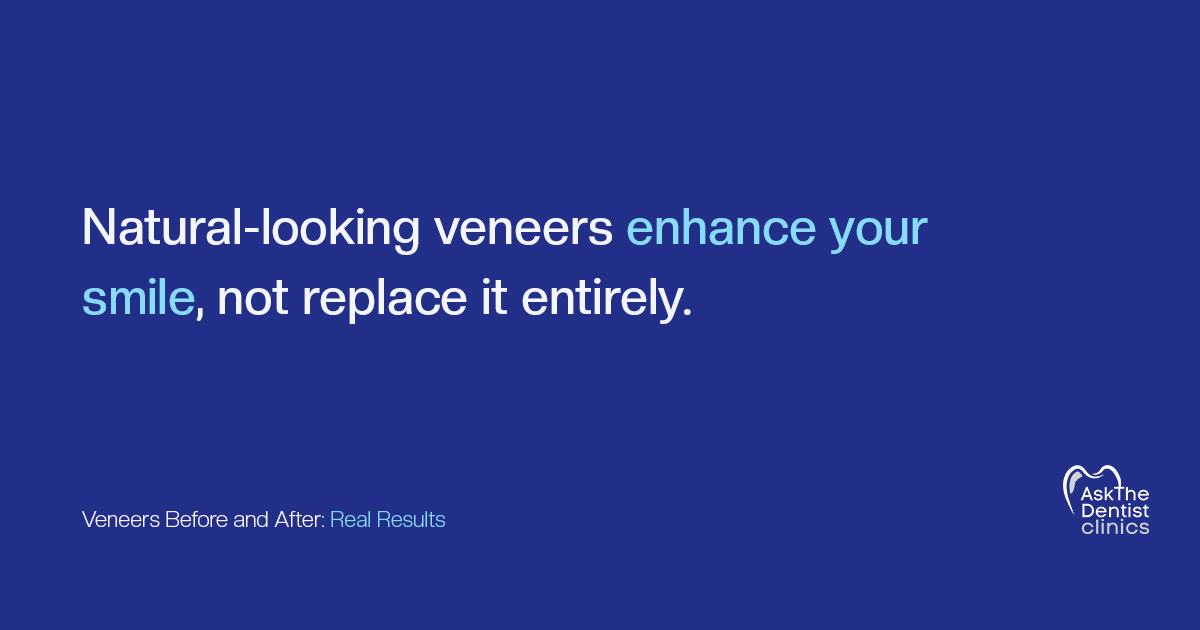 Natural-looking veneers enhance your smile, not replace it entirely