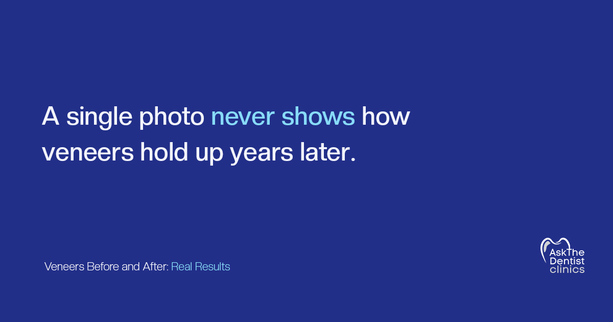 A single photo never shows how veneers hold up years later
