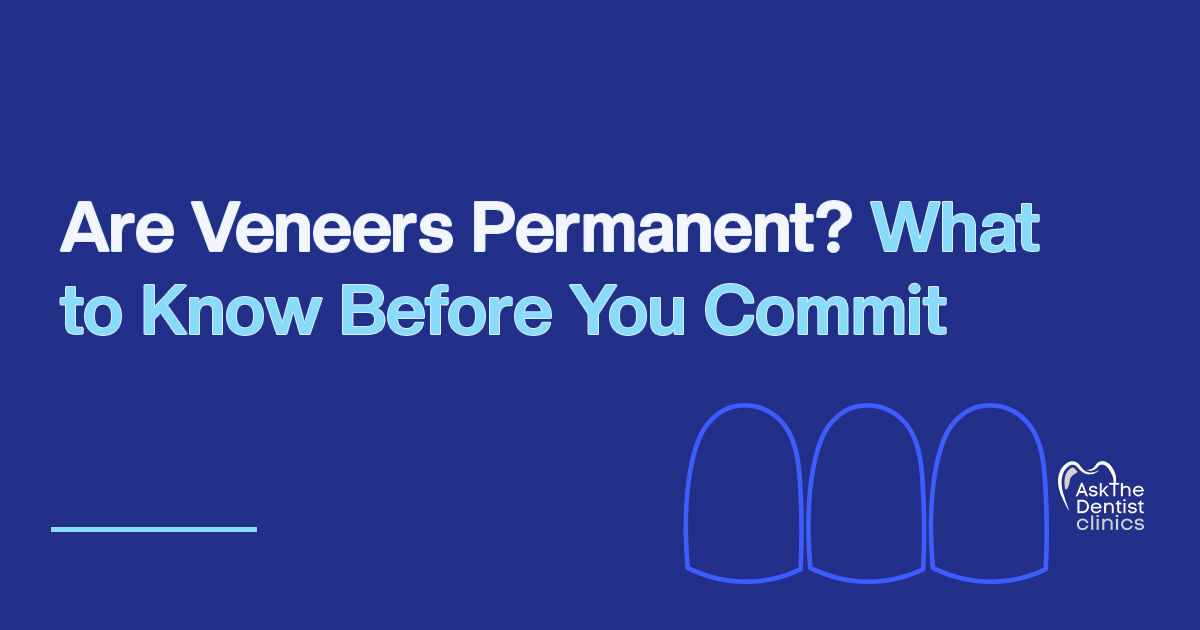 Are Veneers Permanent? What to Know Before You Commit title card