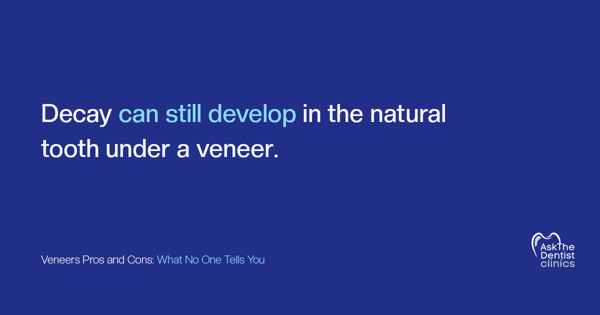 Decay can still develop in the natural tooth under a veneer