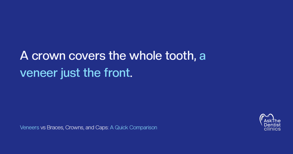 A crown covers the whole tooth, a veneer just the front