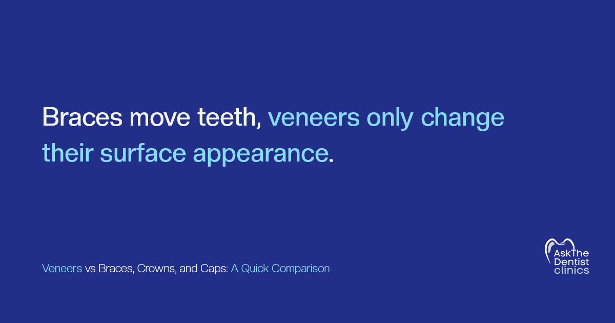 Braces move teeth, veneers only change their surface appearance