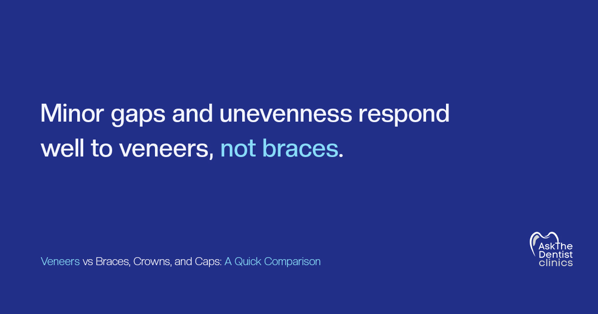 Minor gaps and unevenness respond well to veneers, not braces